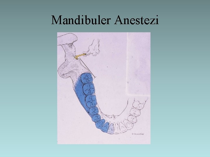 Mandibuler Anestezi 