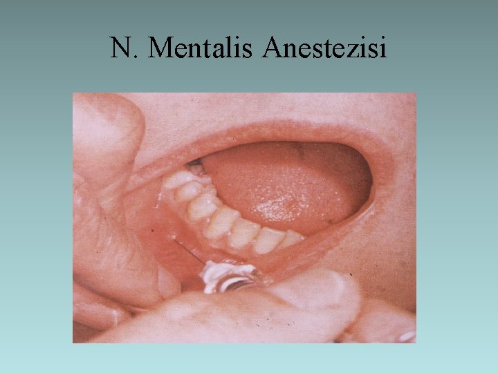 N. Mentalis Anestezisi 