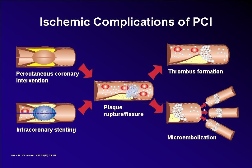 Ischemic Complications of PCI Thrombus formation Percutaneous coronary intervention Plaque rupture/fissure Intracoronary stenting Microembolization