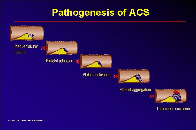 Pathogenesis of ACS White HD. Am J Cardiol. 1997; 80(4 A): 2 B-10 B.