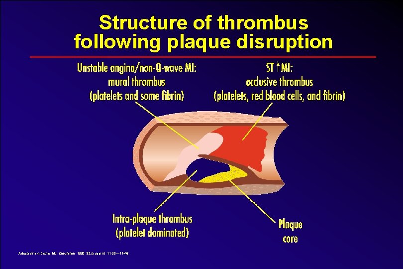 Structure of thrombus following plaque disruption Adapted from Davies MJ. Circulation. 1990; 82 (suppl