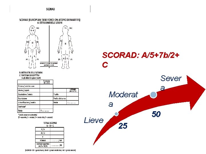 SCORAD: A/5+7 b/2+ C Moderat a Lieve Sever a 50 25 