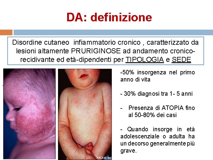 DA: definizione Disordine cutaneo infiammatorio cronico , caratterizzato da lesioni altamente PRURIGINOSE ad andamento