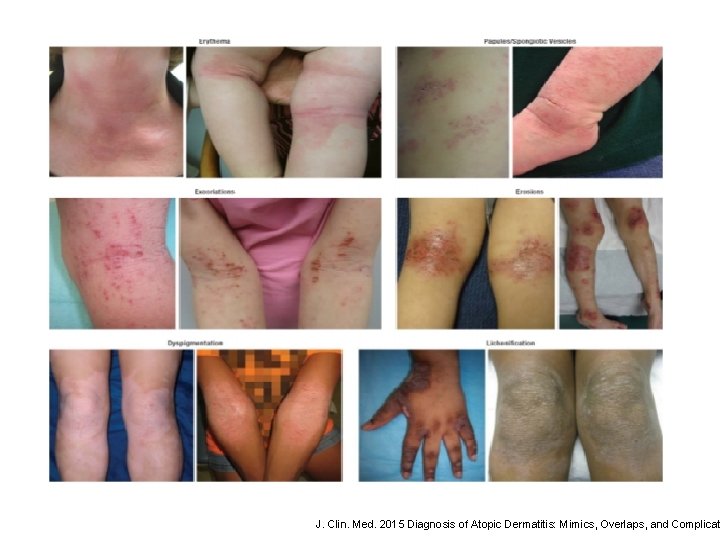 J. Clin. Med. 2015 Diagnosis of Atopic Dermatitis: Mimics, Overlaps, and Complicat 