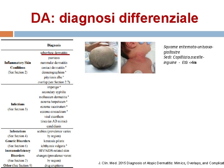 DA: diagnosi differenziale Squame eritemato-untuosogiallastre Sedi: Capilliizio, ascelleinguine - Età <4 m J. Clin.