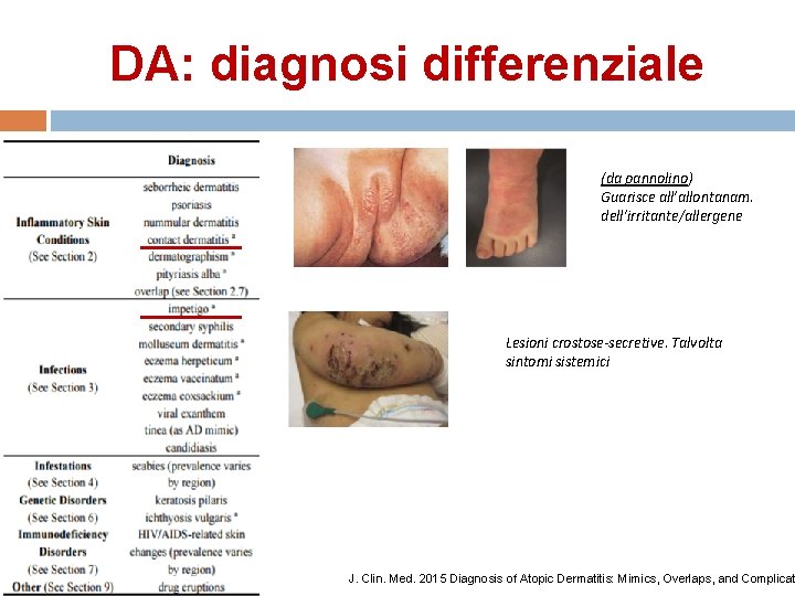 DA: diagnosi differenziale (da pannolino) Guarisce all’allontanam. dell’irritante/allergene Lesioni crostose-secretive. Talvolta sintomi sistemici J.