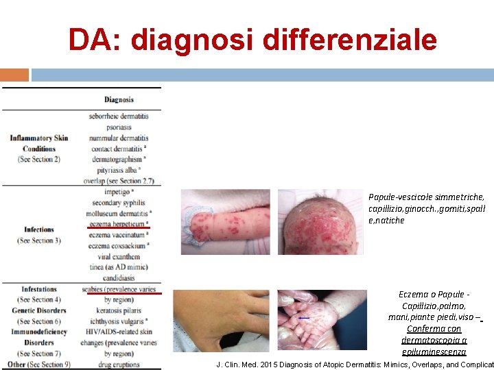 DA: diagnosi differenziale Papule-vescicole simmetriche, capillizio, ginocch. , gomiti, spall e, natiche Eczema o