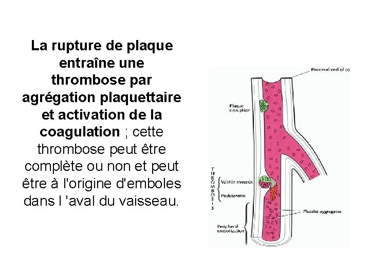 La rupture de plaque entraîne une thrombose par agrégation plaquettaire et activation de la