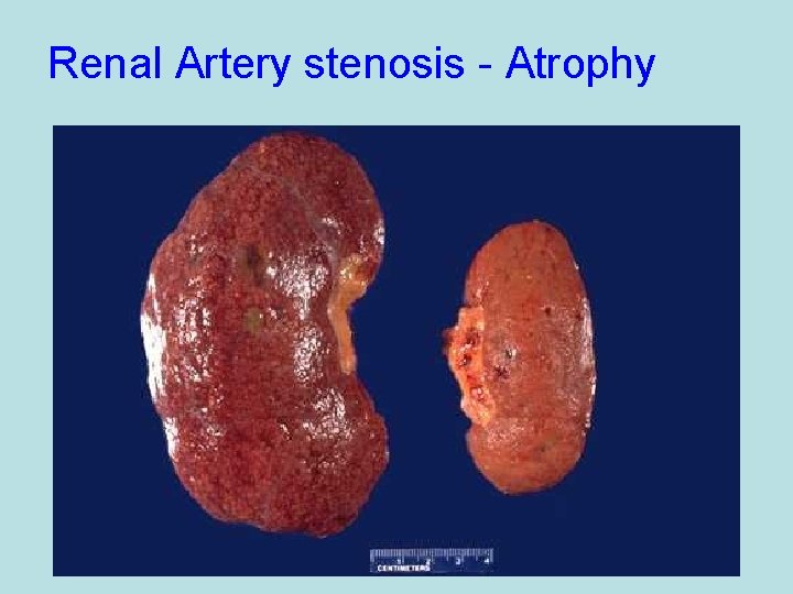 Renal Artery stenosis - Atrophy 