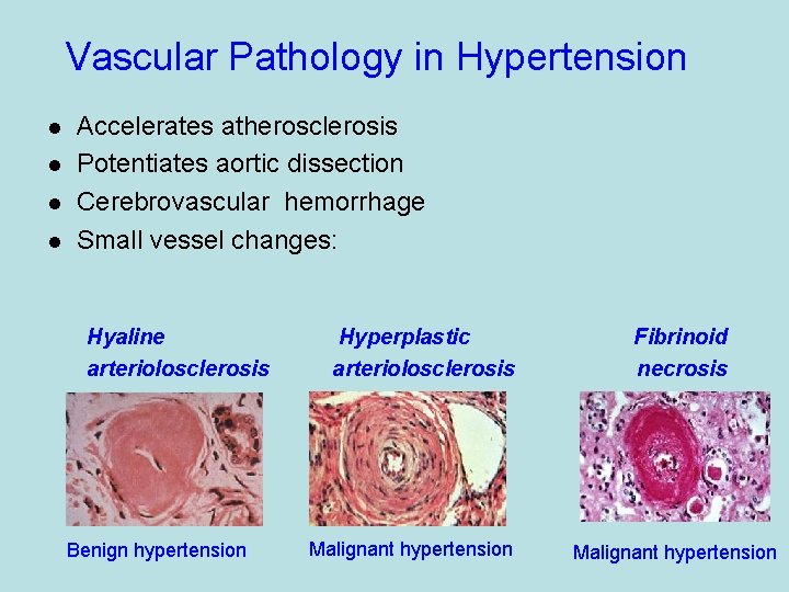 Vascular Pathology in Hypertension l l Accelerates atherosclerosis Potentiates aortic dissection Cerebrovascular hemorrhage Small