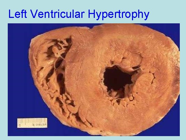 Left Ventricular Hypertrophy 