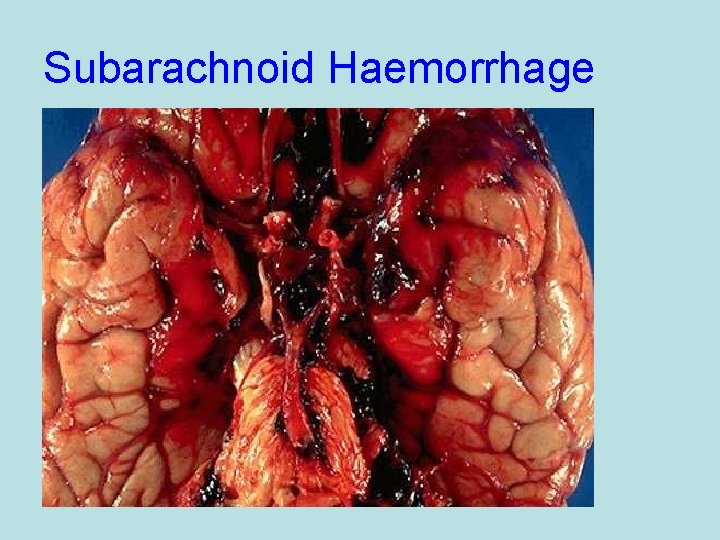 Subarachnoid Haemorrhage 