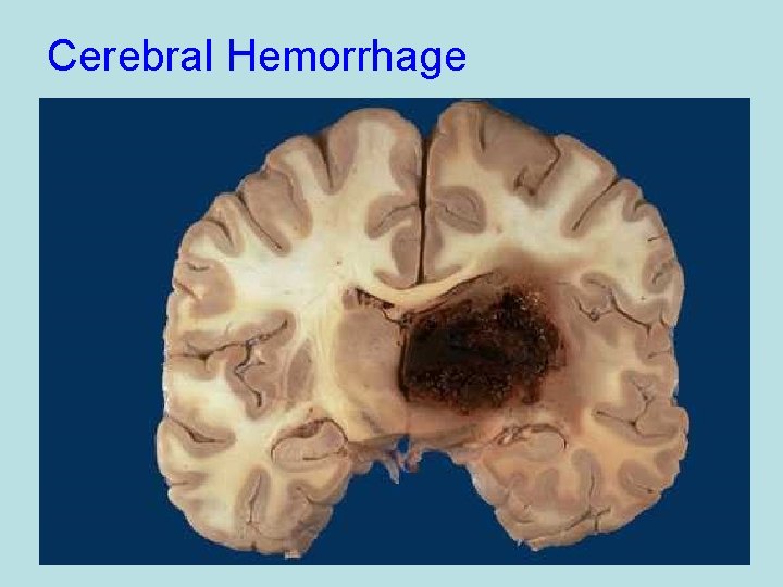 Cerebral Hemorrhage 