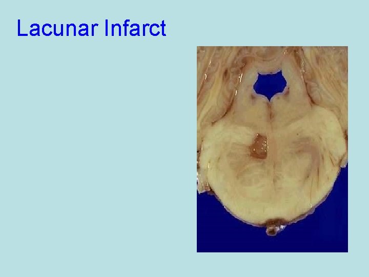 Lacunar Infarct 