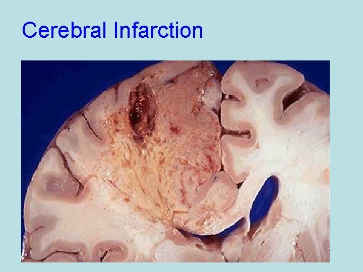 Cerebral Infarction 