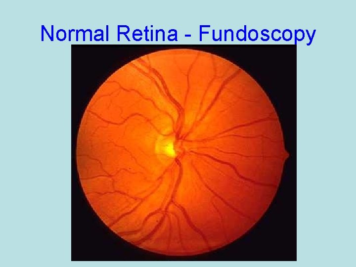 Normal Retina - Fundoscopy 