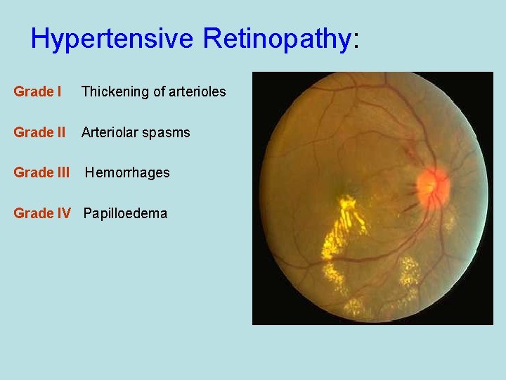 Hypertensive Retinopathy: Grade I Thickening of arterioles Grade II Arteriolar spasms Grade III Hemorrhages