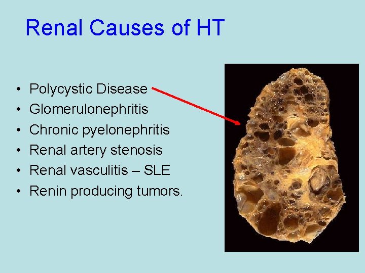 Renal Causes of HT • • • Polycystic Disease Glomerulonephritis Chronic pyelonephritis Renal artery