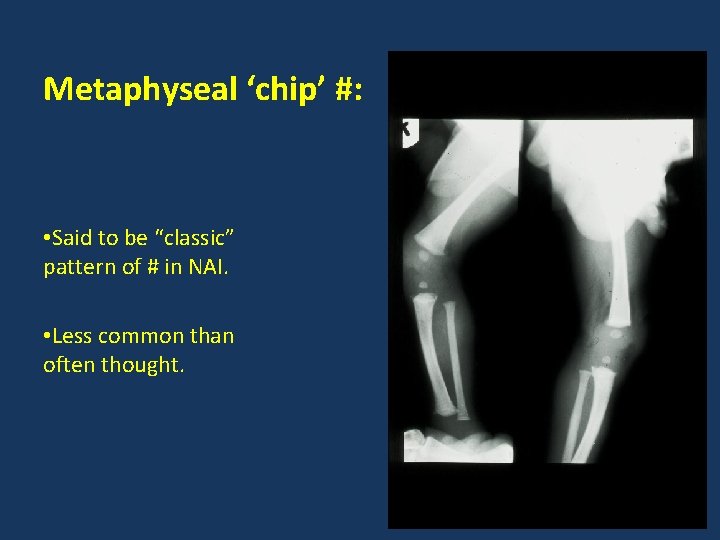 Metaphyseal ‘chip’ #: • Said to be “classic” pattern of # in NAI. •