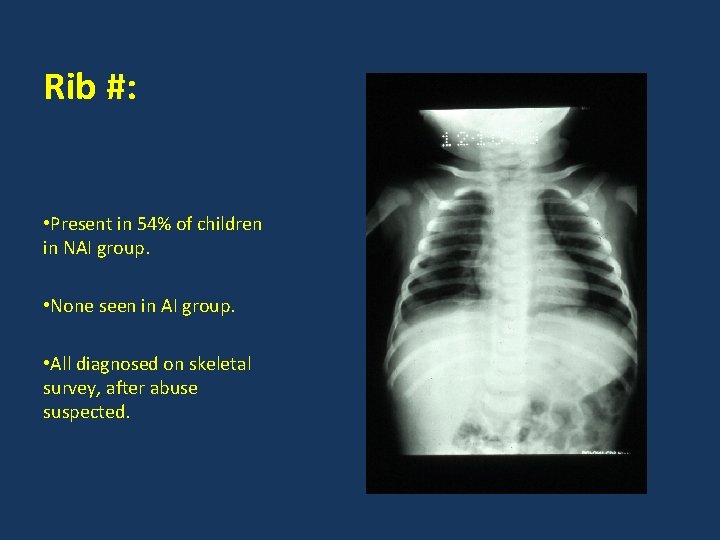 Rib #: • Present in 54% of children in NAI group. • None seen