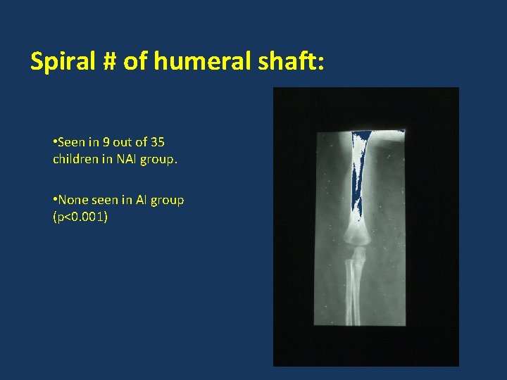 Spiral # of humeral shaft: • Seen in 9 out of 35 children in