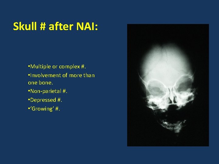 Skull # after NAI: • Multiple or complex #. • Involvement of more than