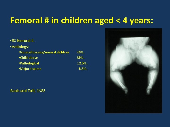 Femoral # in children aged < 4 years: • 80 femoral #. • Aetiology: