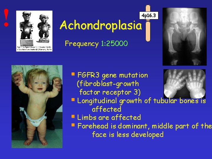 ! 4 p 16. 3 Achondroplasia Frequency 1: 25000 § FGFR 3 gene mutation