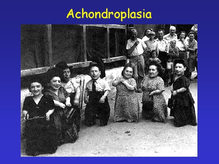 Achondroplasia 