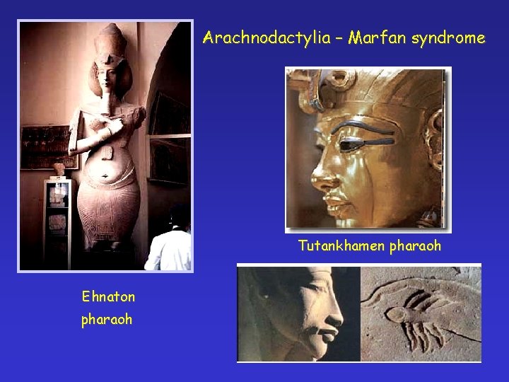 Arachnodactylia – Marfan syndrome Tutankhamen pharaoh Ehnaton pharaoh 