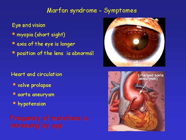 Marfan syndrome - Symptomes Eye and vision § myopia (short sight) § axis of