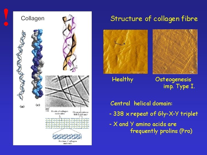 ! Structure of collagen fibre Healthy Osteogenesis imp. Type I. Central helical domain: -