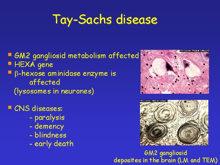 Tay-Sachs disease § GM 2 gangliosid metabolism affected § HEXA gene § b-hexose aminidase