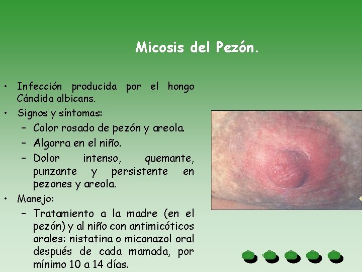 Micosis del Pezón. • Infección producida por el hongo Cándida albicans. • Signos y