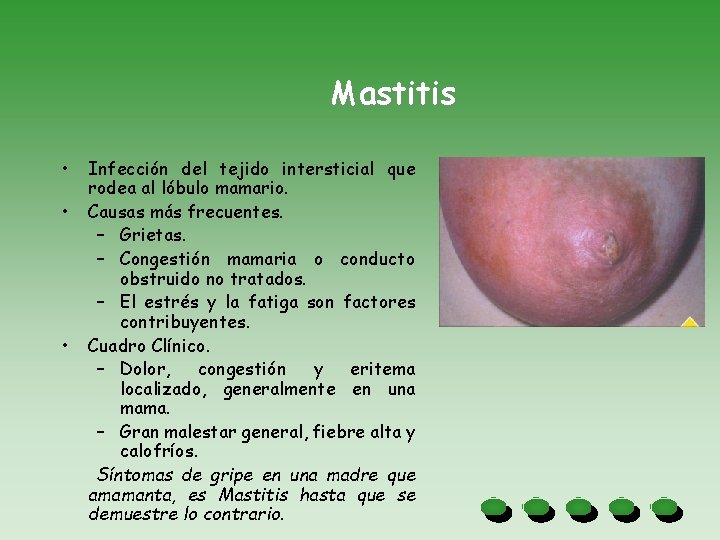 Mastitis • • • Infección del tejido intersticial que rodea al lóbulo mamario. Causas