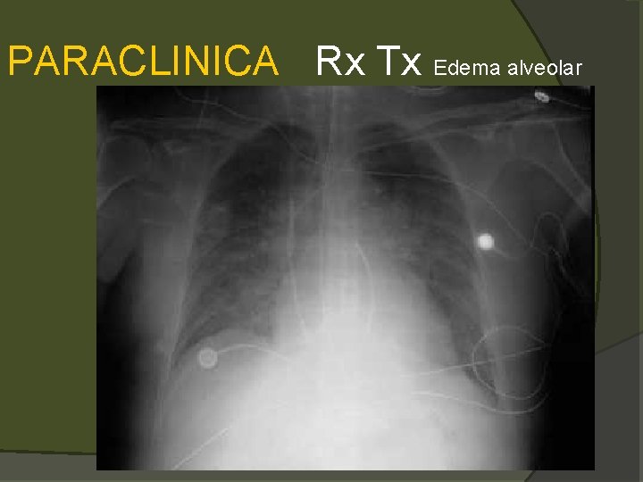 PARACLINICA Rx Tx Edema alveolar 