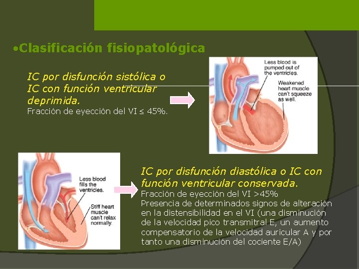  • Clasificación fisiopatológica IC por disfunción sistólica o IC con función ventricular deprimida.