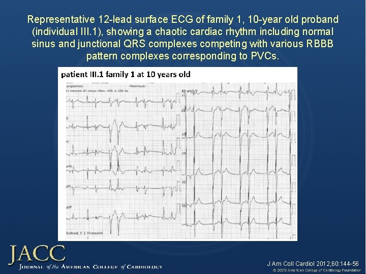 Representative 12 -lead surface ECG of family 1, 10 -year old proband (individual III. Representative 12 -lead surface ECG of family 1, 10 -year old proband (individual III.