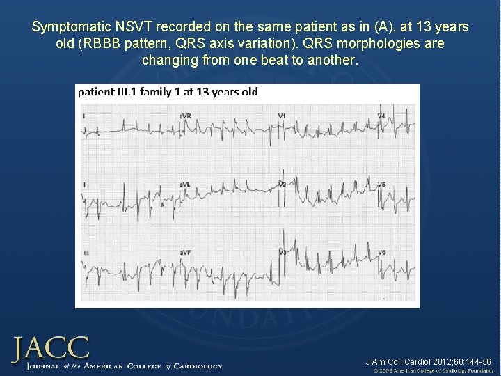 Symptomatic NSVT recorded on the same patient as in (A), at 13 years old