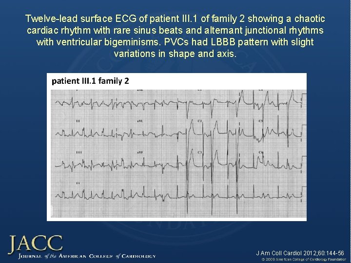Twelve-lead surface ECG of patient III. 1 of family 2 showing a chaotic cardiac