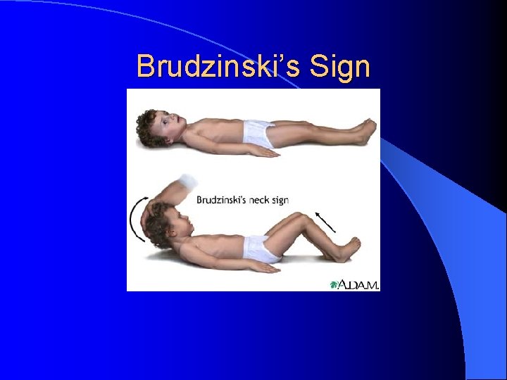 Brudzinski’s Sign 