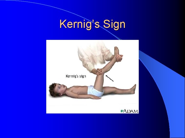 Kernig’s Sign 