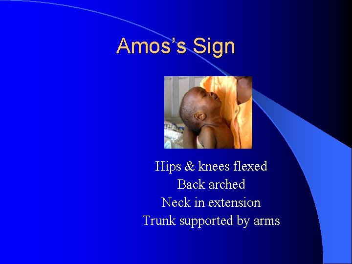 Amos’s Sign Hips & knees flexed Back arched Neck in extension Trunk supported by