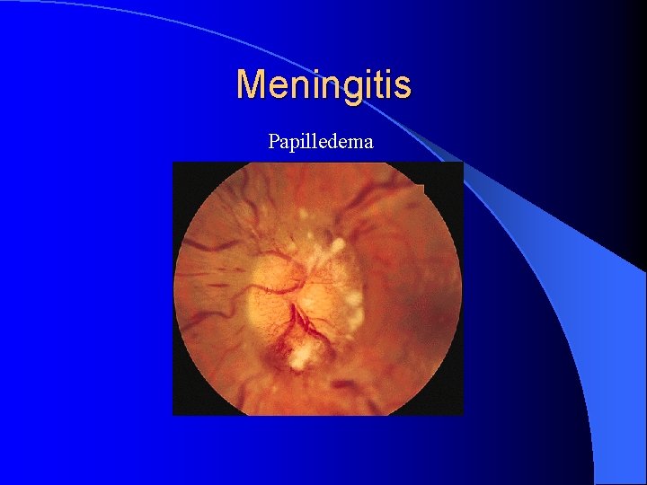 Meningitis Papilledema 