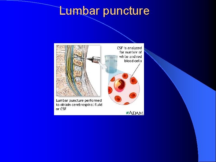 Lumbar puncture 