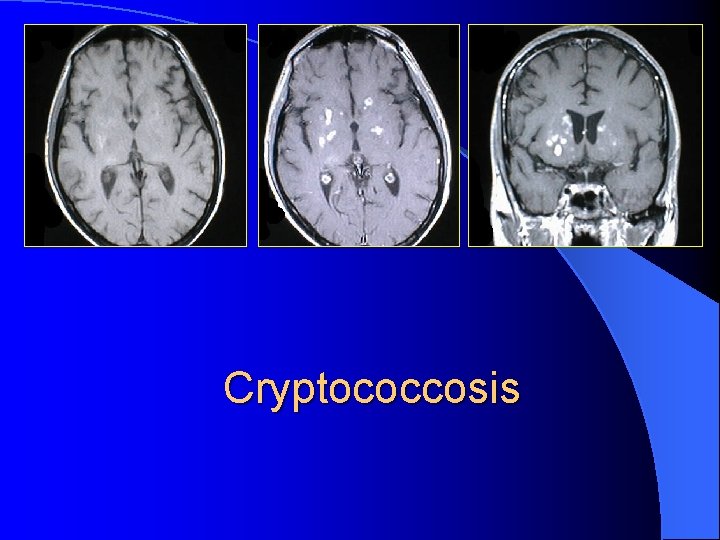 Cryptococcosis 