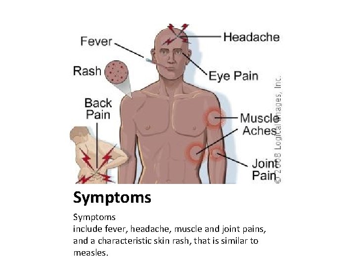 Symptoms include fever, headache, muscle and joint pains, and a characteristic skin rash, that