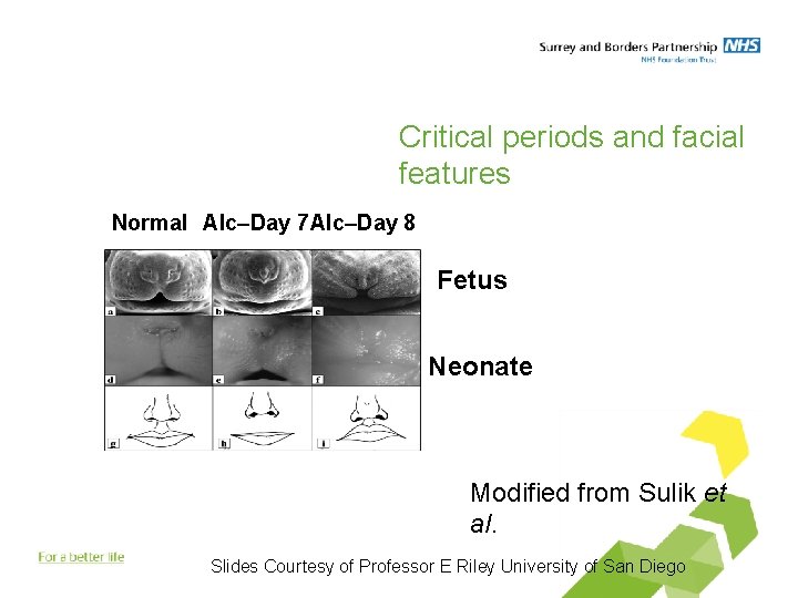 Critical periods and facial features Normal Alc–Day 7 Alc–Day 8 Fetus Neonate Modified from