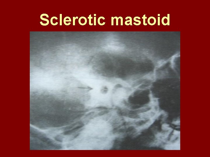 Sclerotic mastoid 