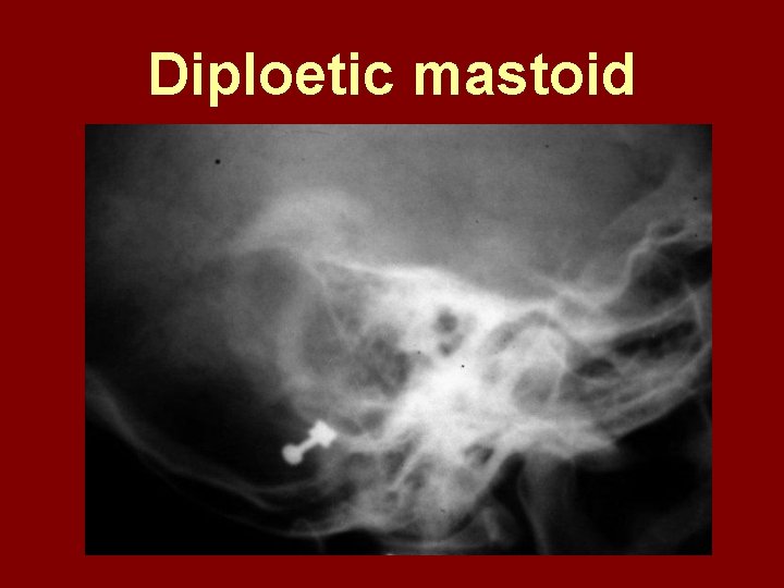 Diploetic mastoid 
